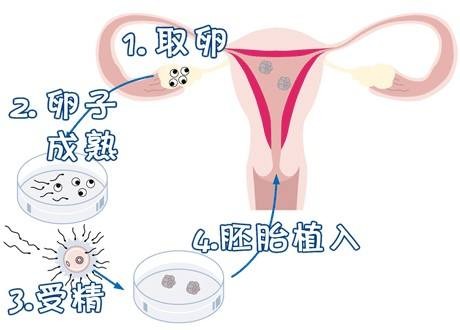 正规供卵代生子